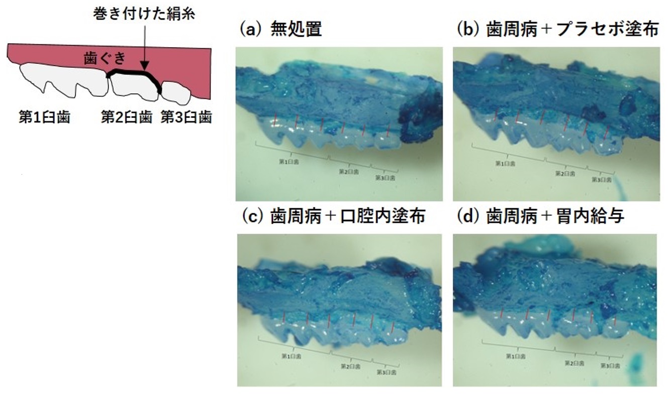 図１：歯周病の進行による歯槽骨吸収の測定